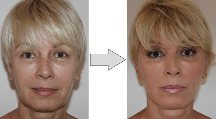 Photo-avant-après-fils-tenseurs-permanents-visage Photo avant-après fils tenseurs permanents visage
