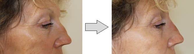 Before & After Rhinoplasty procedures in Nice