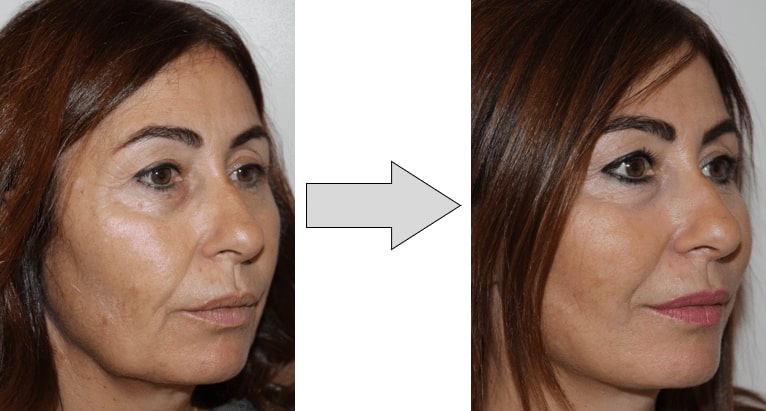 avant-après-fils-tenseurs-permanents-visage-droit Avant-après fils tenseurs permanents visage droit