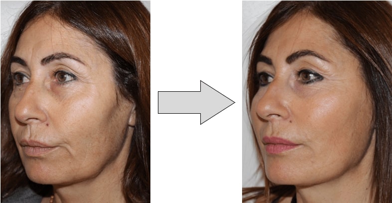 avant-après-fils-tenseurs-permanents-visage-gauche Avant-après fils tenseurs permanents visage gauche