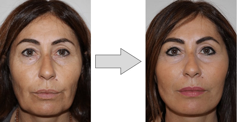 avant-après-fils-tenseurs-permanents-visage Avant-après fils tenseurs permanents visage