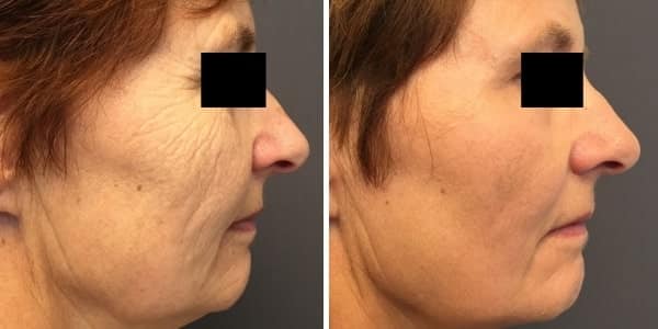 avant-apres-peeling-profond-nice Avant-apres peeling profond nice
