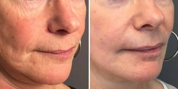 avant-apres-peeling-visage-nice Avant-apres peeling visage nice